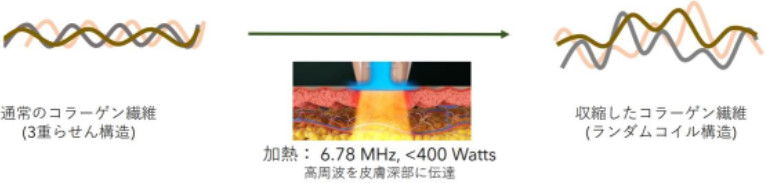 RF治療のメカニズム